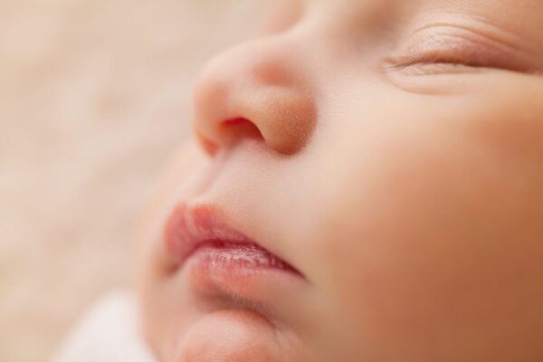 babyacne oorzaak en behandeling